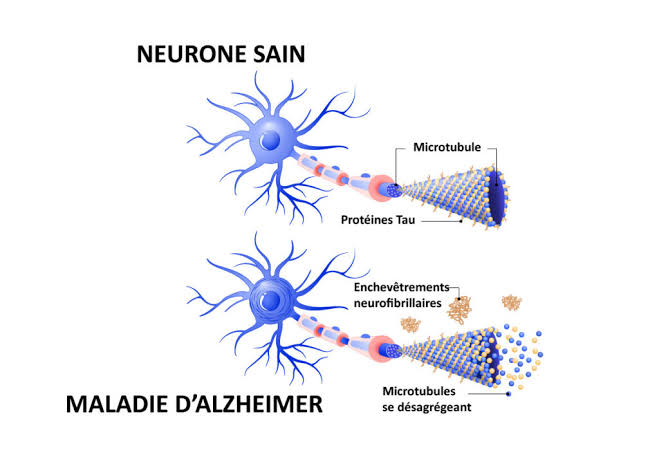 Alzheimer